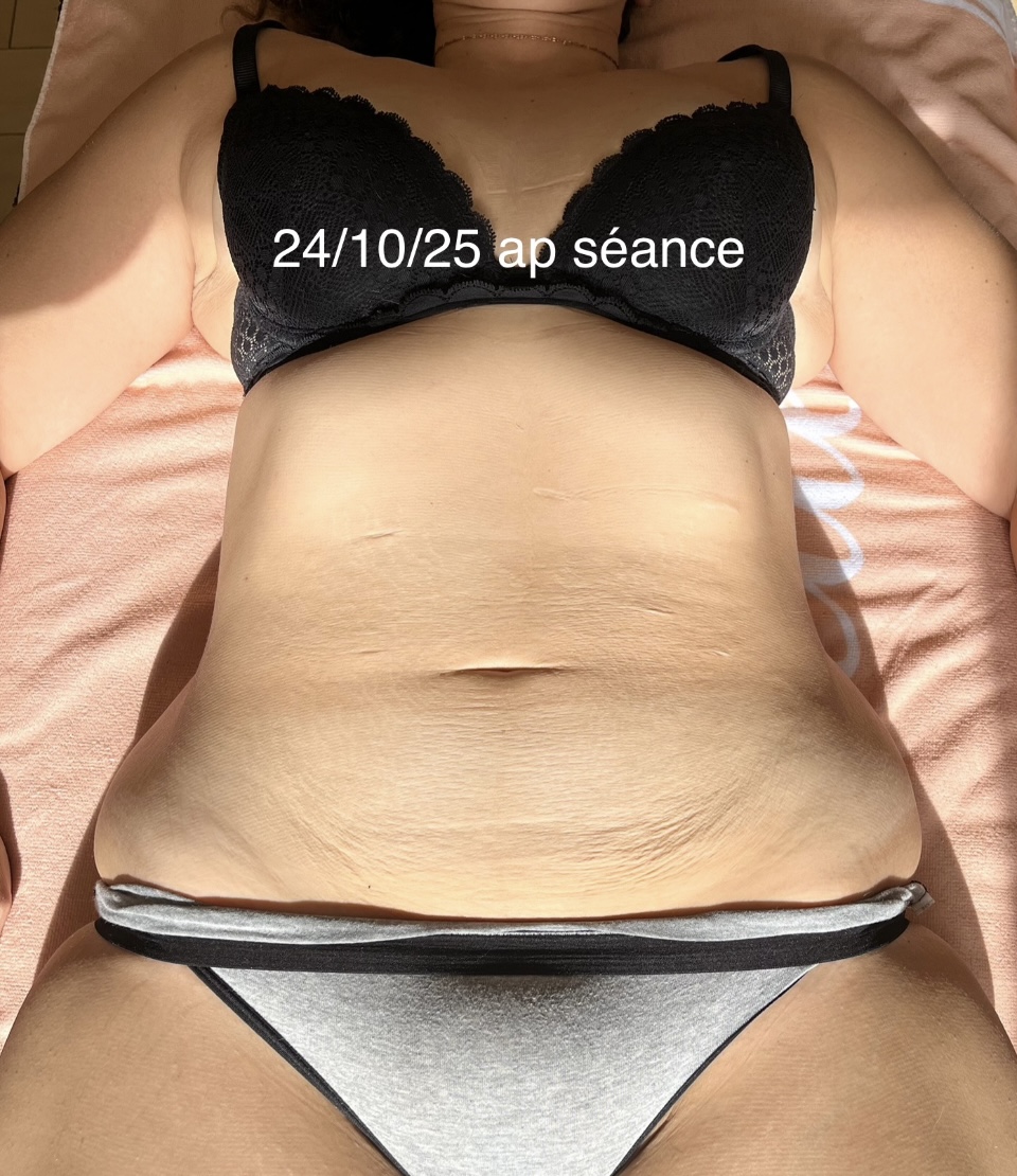 Après drainage lymphatique